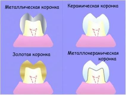 Карієс під коронкою