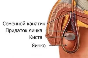Кіста придатка яєчка опис, причини, види і методи лікування (яєчка) Кіста придатка яєчка опис, причини, види і методи лікування