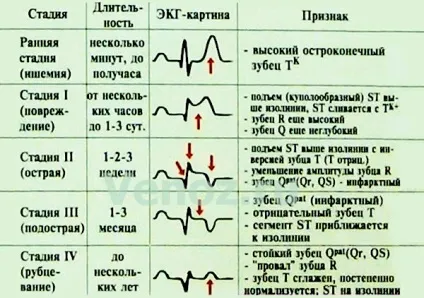 Інфаркт серця, операції на серці, лікування після інфаркту, дієта (харчування) (серце) Інфаркт серця, операції на серці, лікування після інфаркту, дієта (харчування)