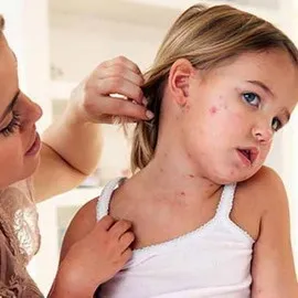 Кір фото симптомів, як передається хвороба, назви вакцин від кору і ускладнення після щеплень (симптомів) Кір фото симптомів, як передається хвороба, назви вакцин від кору і ускладнення після щеплень