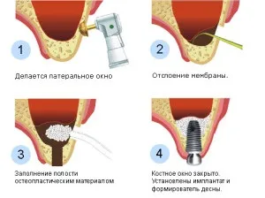 Кісткова тканина зуба видалення, відновлення зруйнованої оболонки щелепи (тканина) Кісткова тканина зуба видалення, відновлення зруйнованої оболонки щелепи