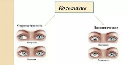 Косоокість у новонароджених до року - коли проходить, причини і лікування (фото) (лікування) Косоокість у новонароджених до року - коли проходить, причини і лікування (фото)