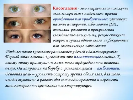 Косоокість у новонароджених до року - коли проходить, причини і лікування (фото) (новонароджених) Косоокість у новонароджених до року - коли проходить, причини і лікування (фото)