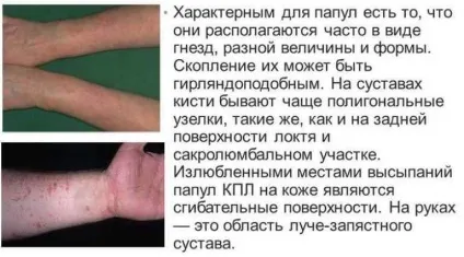 Червоний плоский лишай лікування народними засобами (плоский) Червоний плоский лишай лікування народними засобами