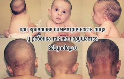 Кривошея у новонароджених ознаки, лікування, масаж (масаж) Кривошея у новонароджених ознаки, лікування, масаж
