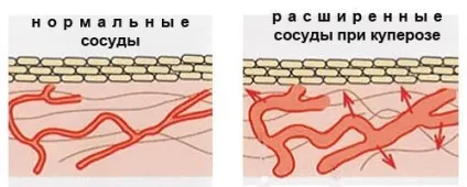 Купероз на обличчі (лікування, препарати, відгуки) (препарати) Купероз на обличчі (лікування, препарати, відгуки)