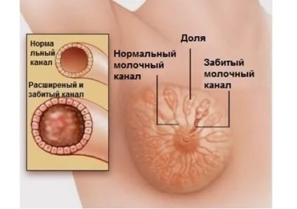 Лактостаз, лікування в домашніх умовах (умовах) Лактостаз, лікування в домашніх умовах