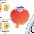 Лікування розсіяного склерозу народними методами (народними) Лікування розсіяного склерозу народними методами