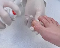 Лікування грибка нігтя, запущена форма як і чим лікувати запущений грибок (лікування) Лікування грибка нігтя, запущена форма як і чим лікувати запущений грибок