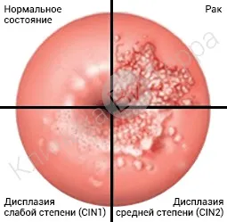 Лікування та діагностика захворювань шийки матки (лікування) Лікування та діагностика захворювань шийки матки