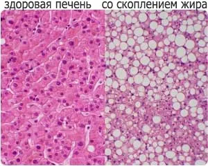 Лікування жирового гепатозу печінки, перші симптоми і ознаки, прогноз і перебіг хвороби при (гепатоза) Лікування жирового гепатозу печінки, перші симптоми і ознаки, прогноз і перебіг хвороби при