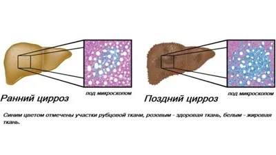 Ліки і препарати для лікування цирозу печінки (таблетки і засоби) (препарати) Ліки і препарати для лікування цирозу печінки (таблетки і засоби)