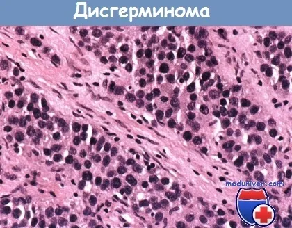 Лікування дісгерміноми і її прогноз (лікування дісгерміноми) Лікування дісгерміноми і її прогноз