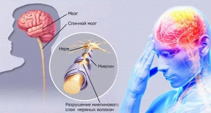 Лікування розсіяного склерозу народними методами (методами) Лікування розсіяного склерозу народними методами