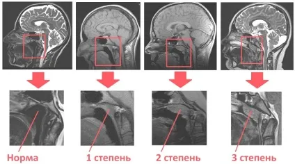 Лікування аденоїдів у дітей без операції сучасні методи (лікування) Лікування аденоїдів у дітей без операції сучасні методи