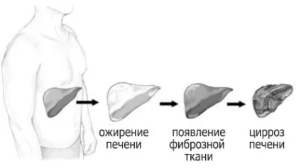 Лікування жирового гепатозу печінки, перші симптоми і ознаки, прогноз і перебіг хвороби при (жирового) Лікування жирового гепатозу печінки, перші симптоми і ознаки, прогноз і перебіг хвороби при