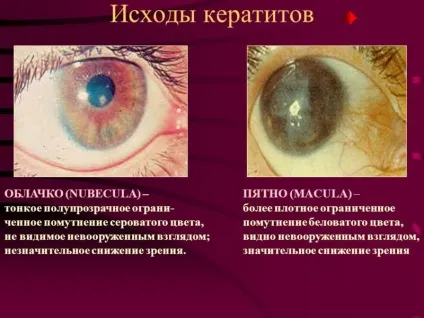 Лікування кератиту народними засобами (лікування) Лікування кератиту народними засобами