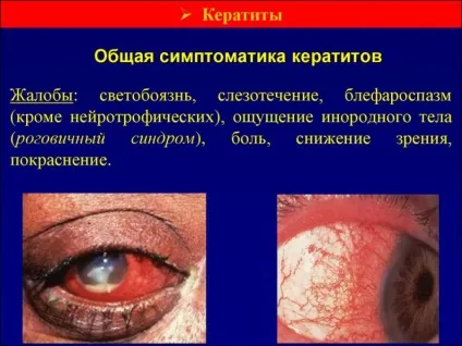 Лікування кератиту народними засобами (кератиту) Лікування кератиту народними засобами