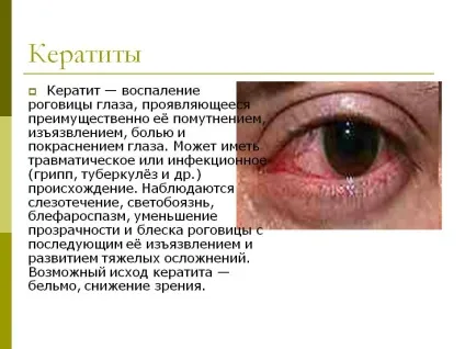 Лікування кератиту народними засобами (народними) Лікування кератиту народними засобами