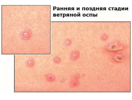 Лікування вітряної віспи - медичний портал eurolab