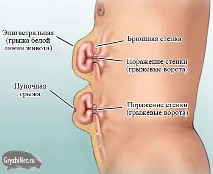 Лікування пупкової грижі у дорослих хірургічне та без операції (дорослих) Лікування пупкової грижі у дорослих хірургічне та без операції