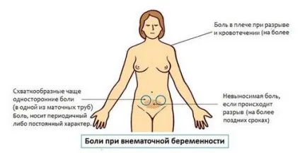 Чи болю позаматкової вагітності (болі позаматкової вагітності) Чи болю позаматкової вагітності