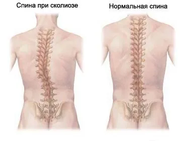 Масаж при сколіозі в домашніх умовах порядок процедур (сколіоз) Масаж при сколіозі в домашніх умовах порядок процедур