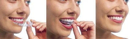 Виправлення прикусу без брекетів за допомогою кап invisalign (кап) Виправлення прикусу без брекетів за допомогою кап invisalign
