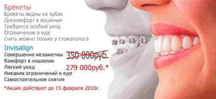 Виправлення прикусу без брекетів за допомогою кап invisalign (допомогою) Виправлення прикусу без брекетів за допомогою кап invisalign