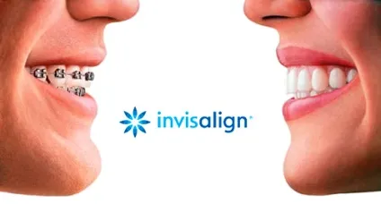 Виправлення прикусу без брекетів за допомогою кап invisalign (кап) Виправлення прикусу без брекетів за допомогою кап invisalign