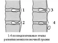 Міжхребцева грижа симптоми, діагностика, лікування (міжхребцева) Міжхребцева грижа симптоми, діагностика, лікування