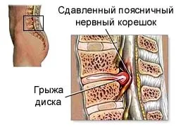 Міжхребцева грижа лікування, види, стадії формування, симптоми захворювання, діагностика (грижа) Міжхребцева грижа лікування, види, стадії формування, симптоми захворювання, діагностика