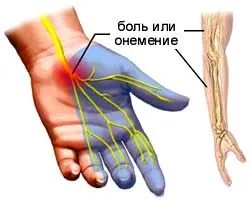Міжхребцева грижа лікування, види, стадії формування, симптоми захворювання, діагностика (діагностика міжхребцевої грижі) Міжхребцева грижа лікування, види, стадії формування, симптоми захворювання, діагностика