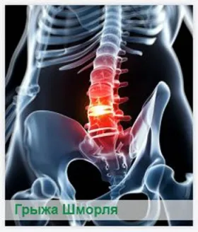 Міжхребцева грижа симптоми, причини, діагностика (зміщення диска сторону) Міжхребцева грижа симптоми, причини, діагностика