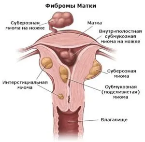 Міома матки лікування народними засобами (лікування) Міома матки лікування народними засобами