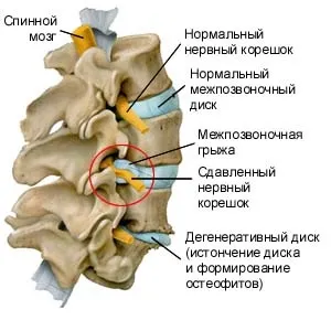 Міжхребцева грижа лікування, види, стадії формування, симптоми захворювання, діагностика (міжхребцева) Міжхребцева грижа лікування, види, стадії формування, симптоми захворювання, діагностика