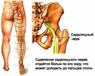 Міжхребцева грижа лікування, види, стадії формування, симптоми захворювання, діагностика (стадії формування) Міжхребцева грижа лікування, види, стадії формування, симптоми захворювання, діагностика