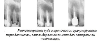 Метод латеральної конденсації