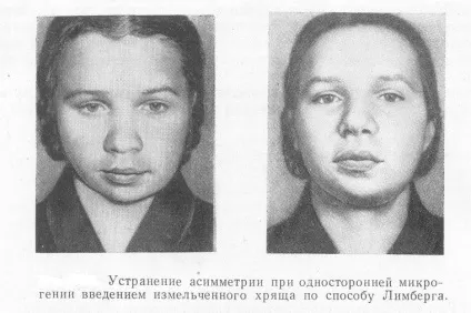 Мікрогенія нижньої щелепи причини, симптоми і лікування аномалії (щелепи) Мікрогенія нижньої щелепи причини, симптоми і лікування аномалії