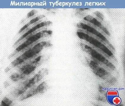 Міліарний туберкульоз легень - клініка, діагностика (міліарний туберкульоз легень) Міліарний туберкульоз легень - клініка, діагностика