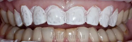 Моментальне відбілювання зубів лаком dental paint (рекламний обман) Моментальне відбілювання зубів лаком dental paint