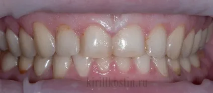 Моментальне відбілювання зубів лаком dental paint (голлівудська усмішка) Моментальне відбілювання зубів лаком dental paint