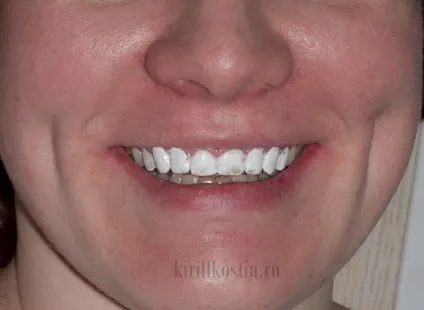 Моментальне відбілювання зубів лаком dental paint (естетична стоматологія) Моментальне відбілювання зубів лаком dental paint