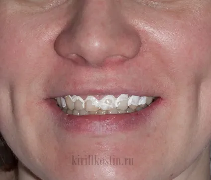 Моментальне відбілювання зубів лаком dental paint (зубів) Моментальне відбілювання зубів лаком dental paint