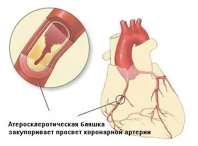 Мрт (томографія) серця і коронарних судин (коронарних) Мрт (томографія) серця і коронарних судин