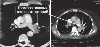 Мрт (томографія) серця і коронарних судин (судин) Мрт (томографія) серця і коронарних судин