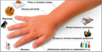 Чи можна при кропивниці митися, купатися в морі, засмагати на сонці, приймати душ