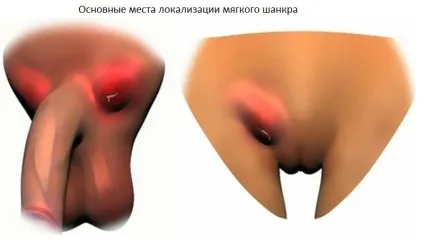 М'який шанкр фото у жінок і чоловіків, як виглядає шанкроїд (фото) М'який шанкр фото у жінок і чоловіків, як виглядає шанкроїд