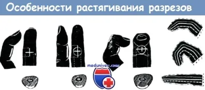 Напрямки ліній Лангера на кисті (ліній) Напрямки ліній Лангера на кисті