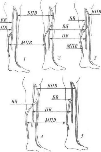 Неспроможність остиального клапана малої підшкірної вени (глава 5. диференційний діагноз варикозної хвороби) Неспроможність остиального клапана малої підшкірної вени